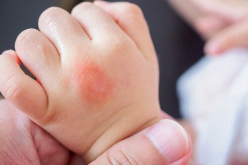 How to Identify Insect Bites in Children?