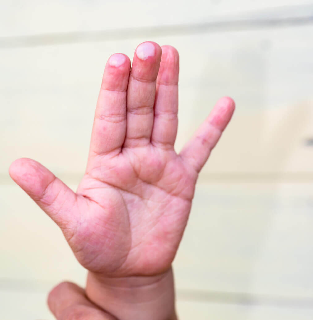 A baby with burns on his fingertips.