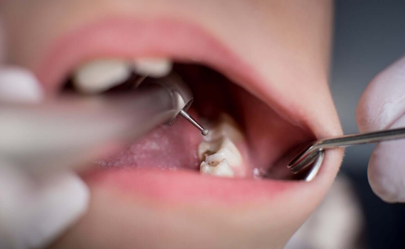 A dentist looking at cavities in a child's mouth.