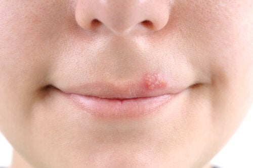 The Natural Treatment of Herpes in Children