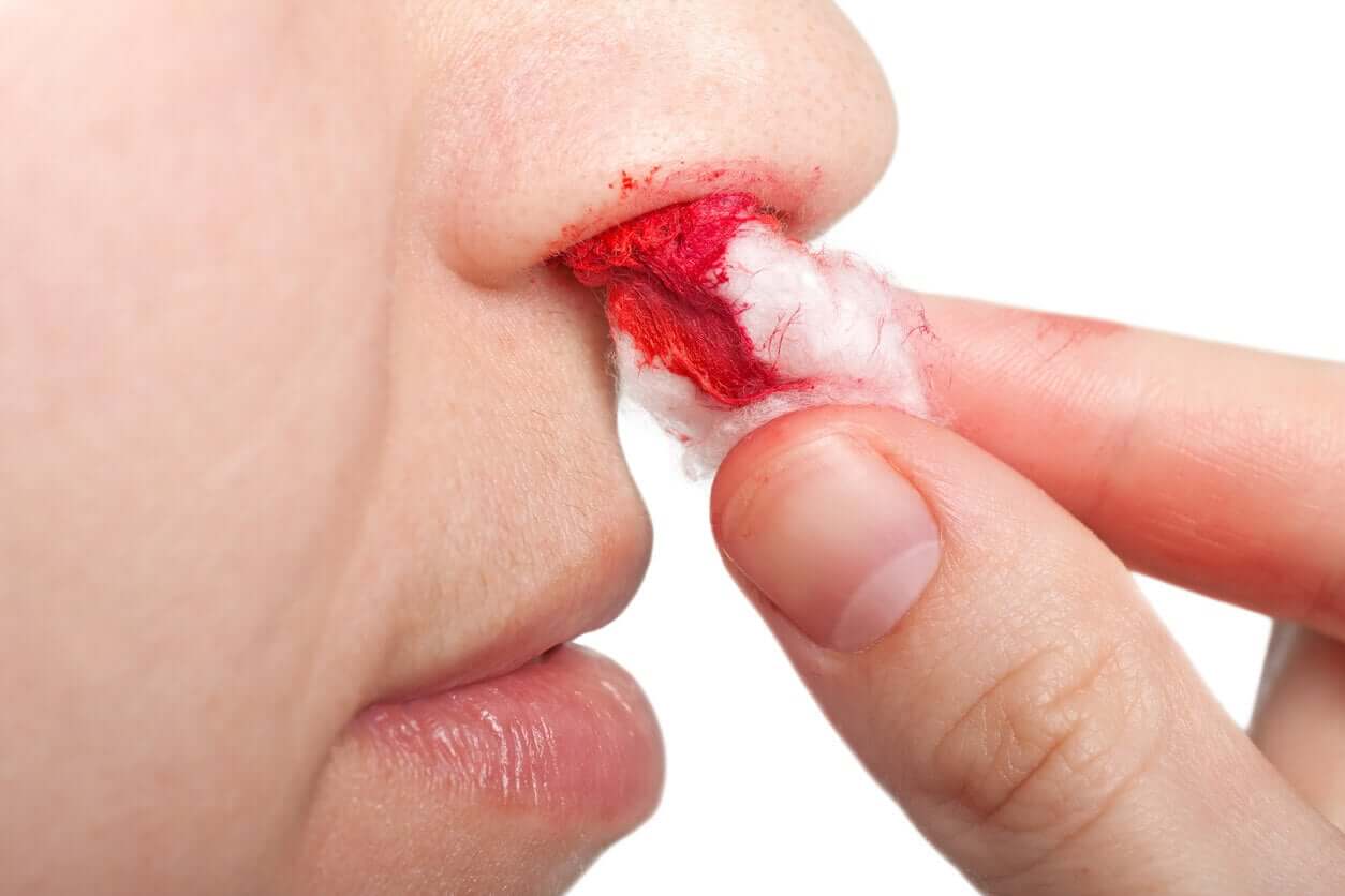 A woman with a nose bleed.