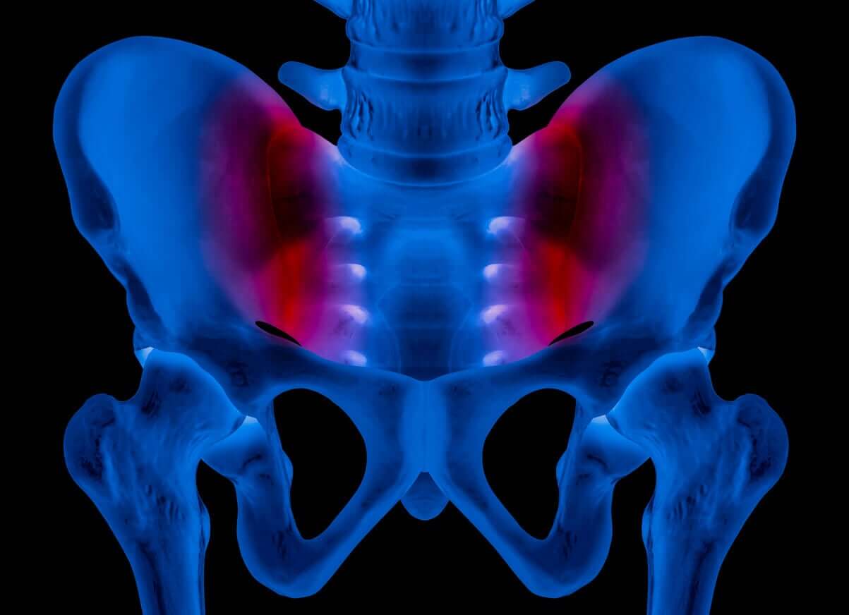 An X-ray image of inflammation in the sacroiliac joints.
