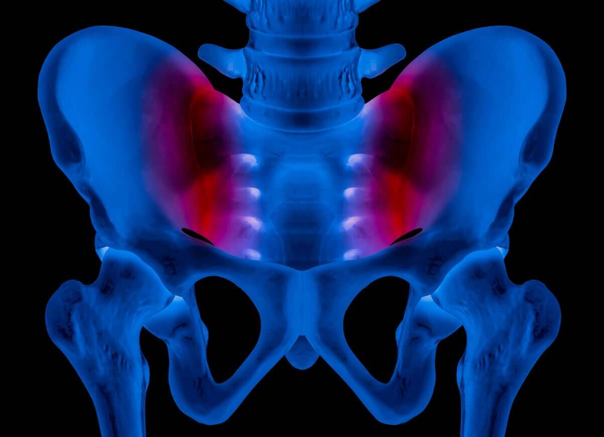 En röntgenbild av inflammation i sacroiliacalederna.