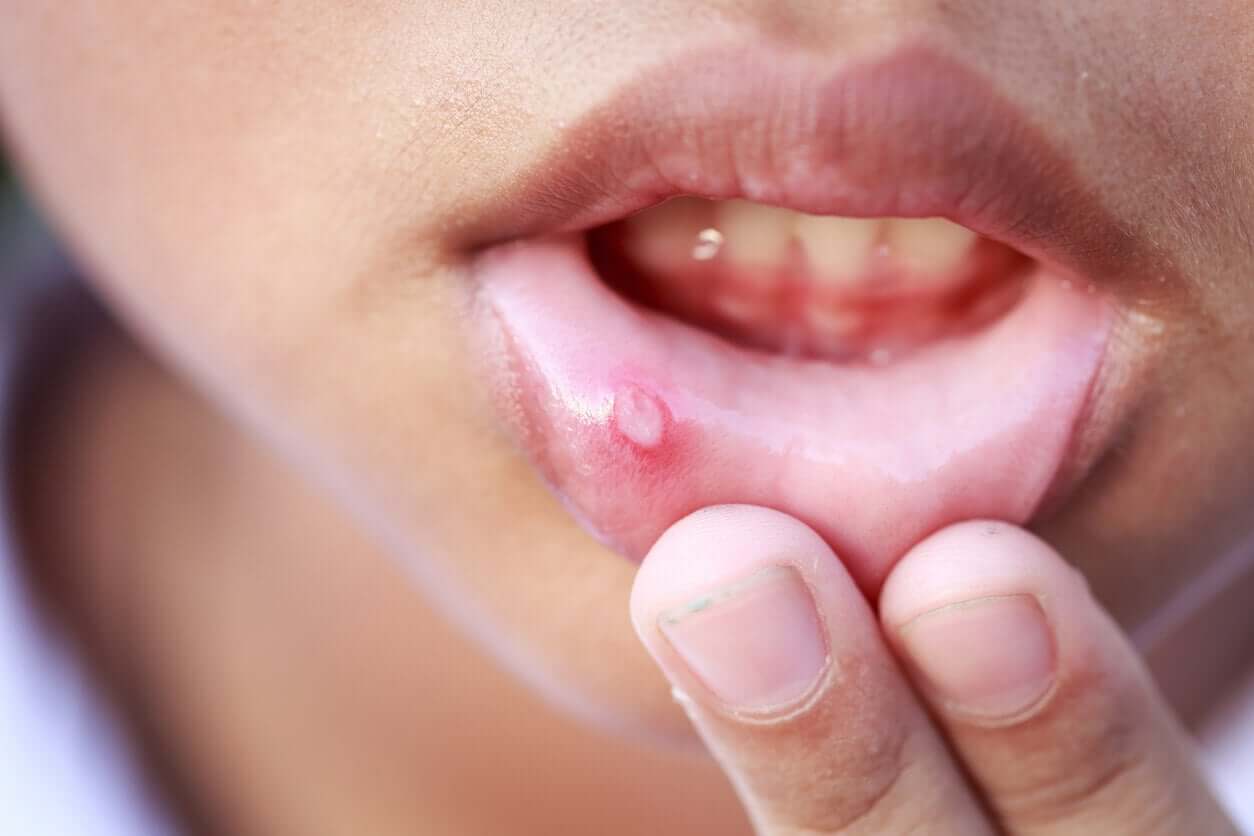A child with a canker sore on her lower lip.