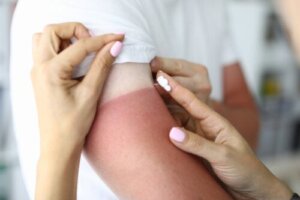 10 Natural Remedies for Sunburn