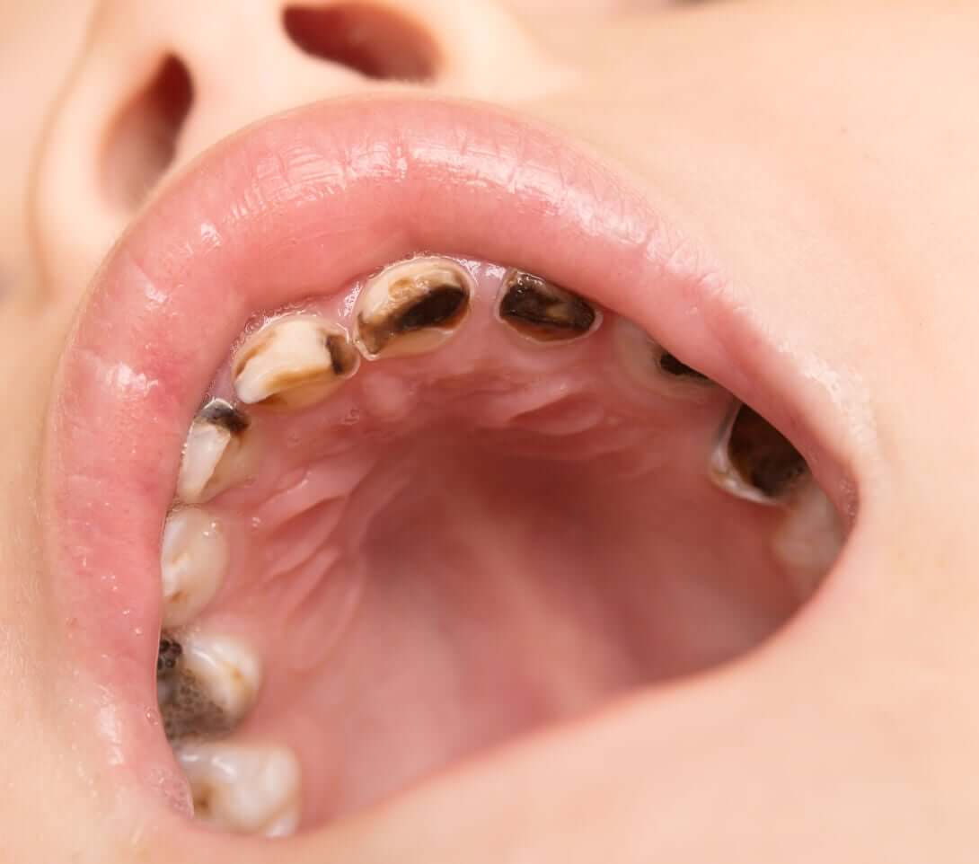 Ett barn med stora hål i tänderna.