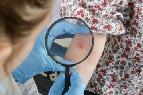 Natural Remedies for Atopic Dermatitis in Babies and Children