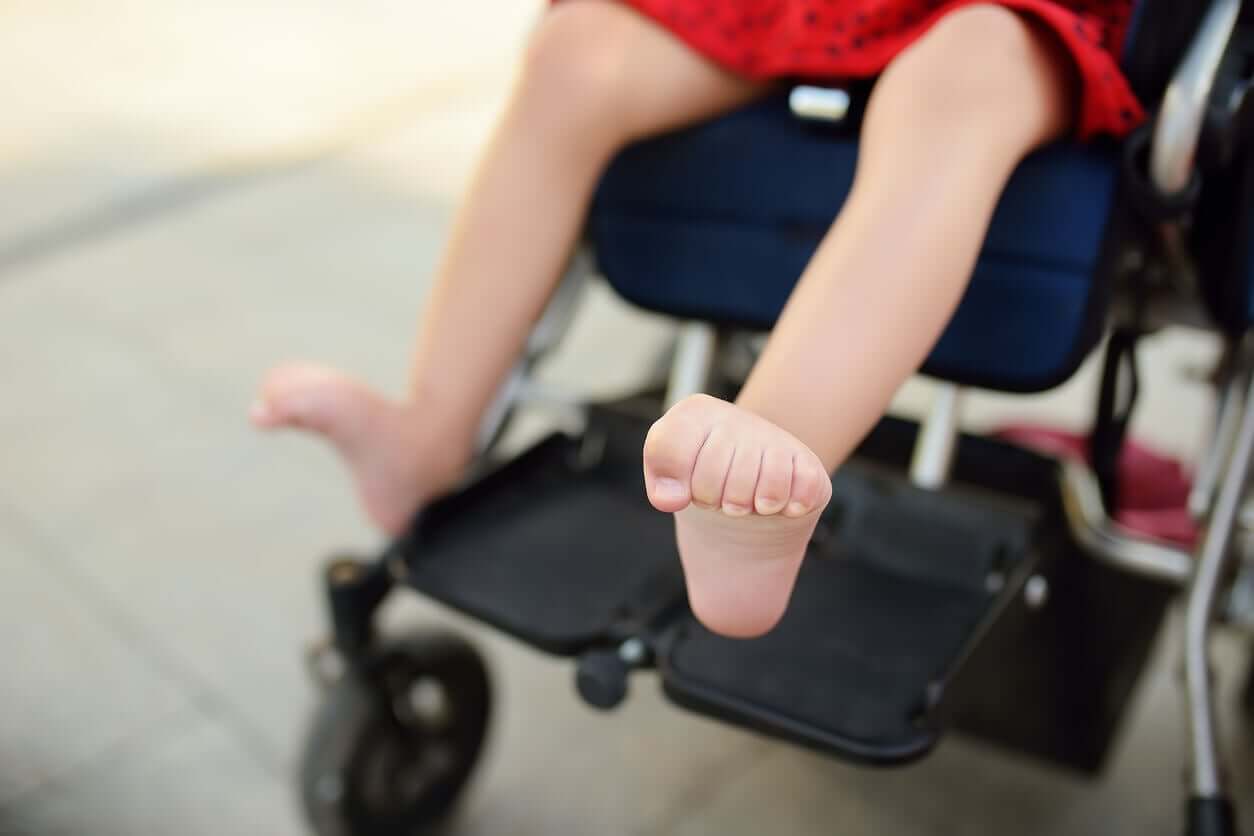 A child with clenched feet because he has hypertonia.