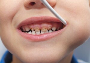 Why Does My Child Have a Darkened Baby Tooth?