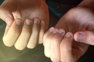 Onychophagia in Children: What You Need to Know