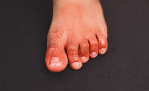 9 Home Remedies for Chilblains