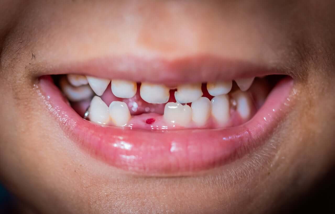 A child with a missing baby tooth.