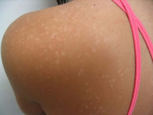 A girl with white speckles on the skin of her shoulder.