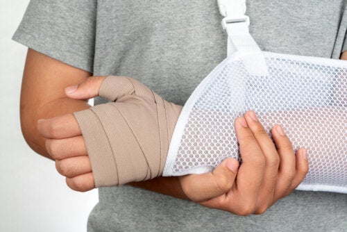 Ett barn med bruten arm.