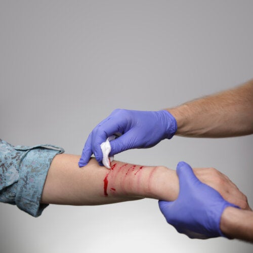 Cutting in Adolescence: What You Should Know