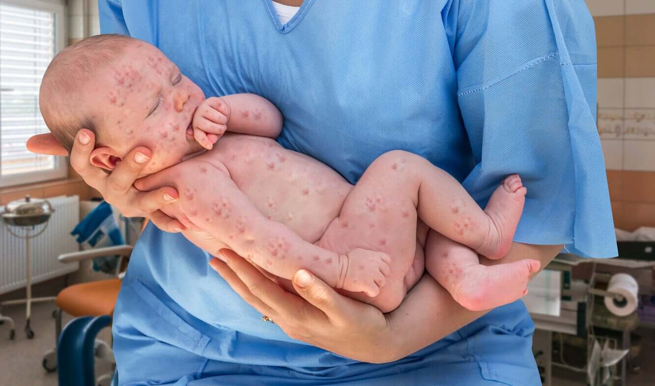 En baby täckt av röda fläckar.