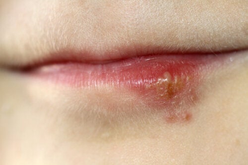 Cold Sores During Pregnancy: What You Need to Know
