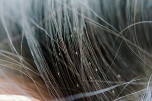 Nits: What Are Lice Eggs Made Of?