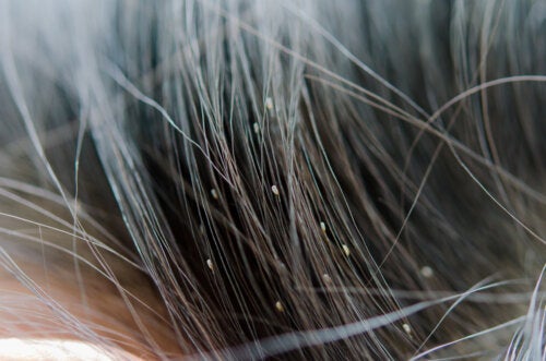 Nits: What Are Lice Eggs Made Of?