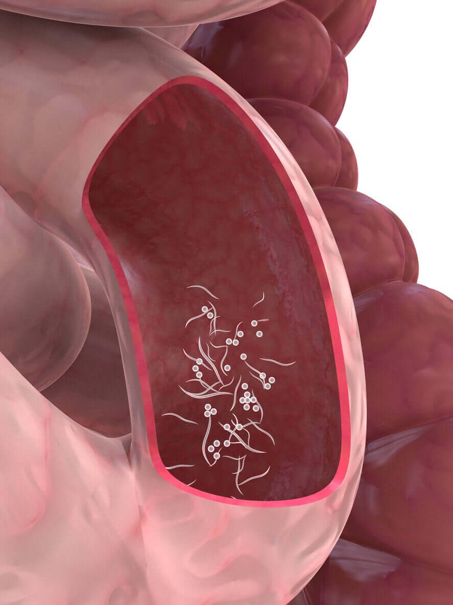 A digital illustration of pinworms in the intestine.