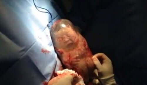 A baby born with the amniotic sac intact.