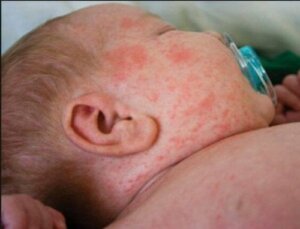 What Are Those Little Red Spots on My Baby's Skin?