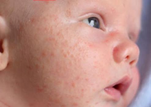 What is Infant Acne?