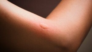Guide to Identifying Insect Bites in Children