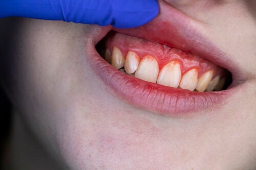 Inflamed Gums In Children Symptoms Causes And Treatment
