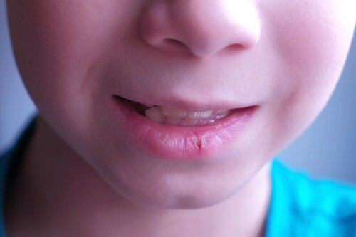 Chapped Lips in Children: Causes and Recommendations