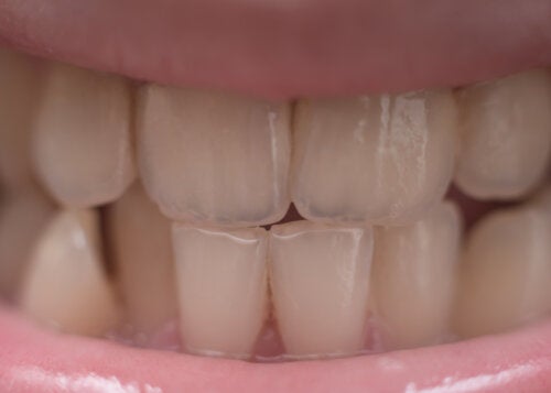 Can Fluoride Discolor Children's Teeth?