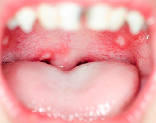 Gingivostomatitis in Children: What You Should Know