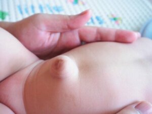 Umbilical Hernias in Babies: Everything You Need to Know
