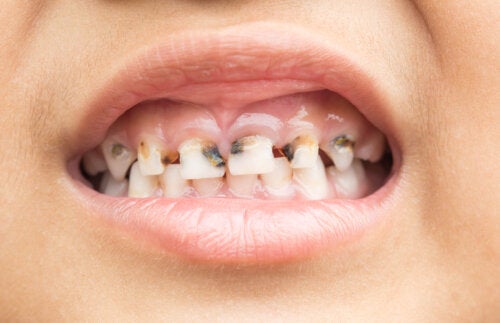 Is It Necessary to Treat Cavities in Baby Teeth?