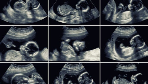 20-Week Ultrasound: Why is it So Important?