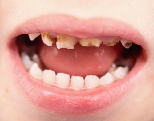Pitted Teeth in Children: Causes and Treatments