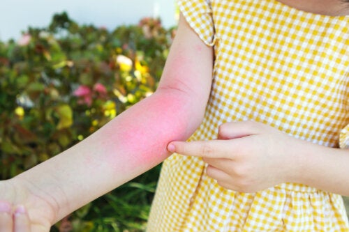 10 Tips for Treating Contact Dermatitis in Children