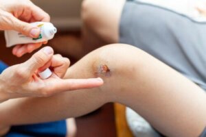 How to Treat Infected Wounds in Children