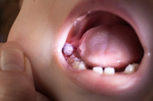 Dental Cysts in Children: How to Treat Them