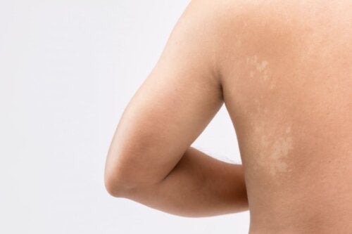 Pityriasis Versicolor in Adolescents: What You Should Know