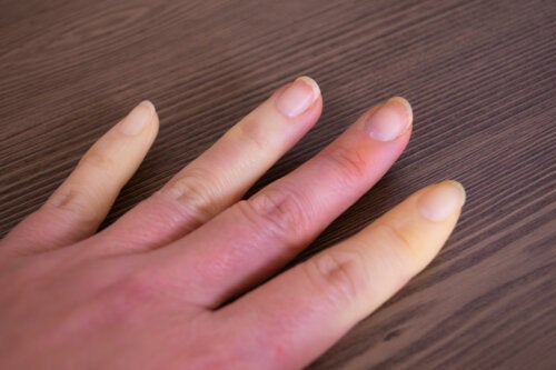 What is Raynaud's Syndrome?