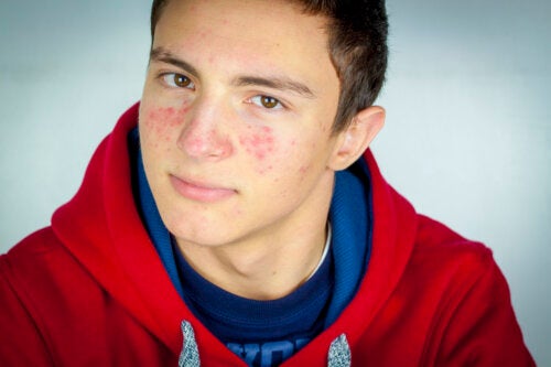 Acne in Teenagers: Do's and Don'ts