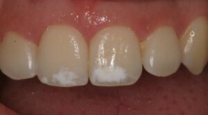 Dental Hypoplasia in Children: Symptoms, Causes, and Treatment