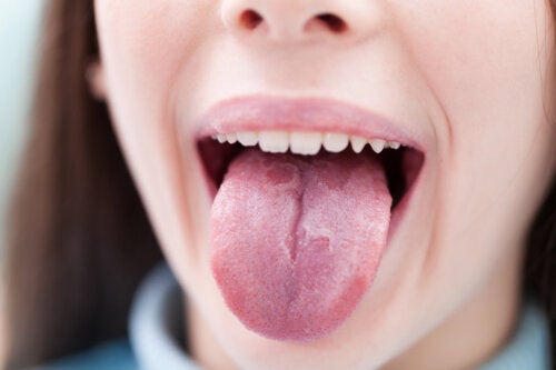 6 Childhood Illnesses that Can Affect the Tongue