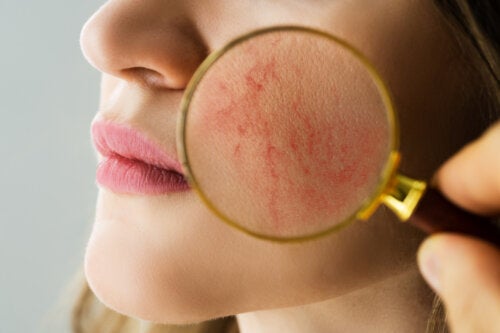 Rosacea During Pregnancy: Causes, Symptoms, and Treatment