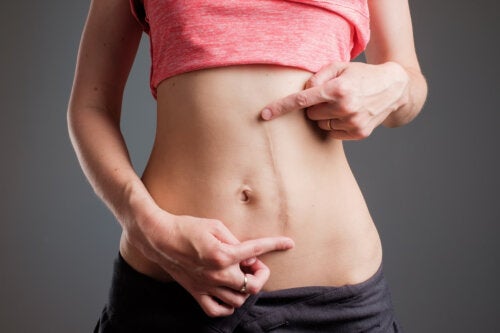 How to Care for Abdominal Scars During Pregnancy