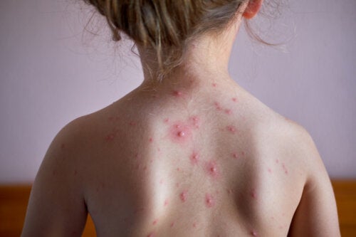 Shingles in Children: What Is It and How Does It Affect Them?