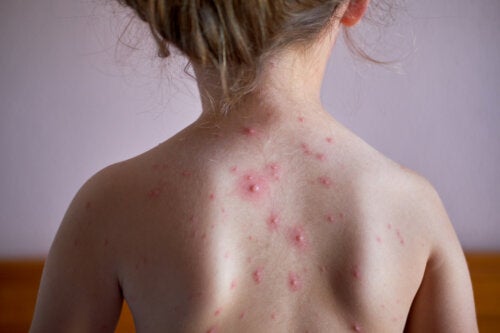 Shingles in Children: What Is It and How Does It Affect Them?