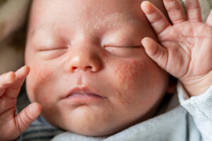 My Baby Has Reactive Skin