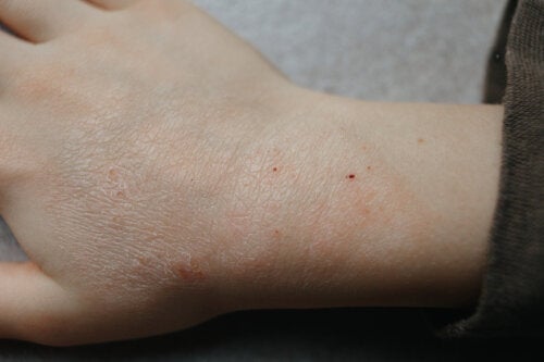 Cutaneous Mycoses in Children